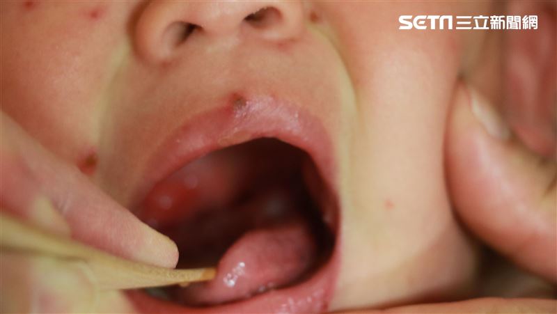 中醫師提醒，驚蟄常見「水痘」疾病，無論小孩、成人都要注意。（圖／台中慈院提供）