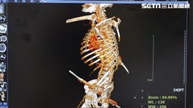 鋼筋貫穿過身體的檢查影像（圖／大林慈院提供）
