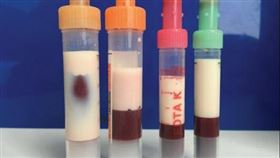  39歲男就醫抽血…驚見「豬油」醫護全嚇壞 圖翻攝自Dcard