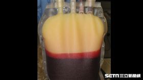 乳糜血(香港紅十字會輸血服務中心提供)