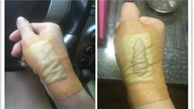 燙傷　人工皮　翻攝自dcard