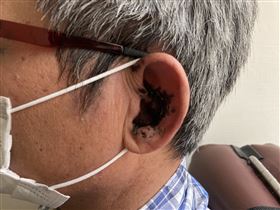 中年男「皮蛇」大爆發　顏面神經麻痺（南投醫院提供）