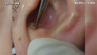耳內藏巨粉刺　美容師連根拔起爽翻