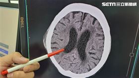 紅筆所指黑色區塊即是腦部積水之處（圖／長安醫院提供）
