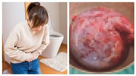 30歲婦劇烈腹痛就醫，揪出18公分「臉盆大」卵巢瘤（門諾醫院提供）