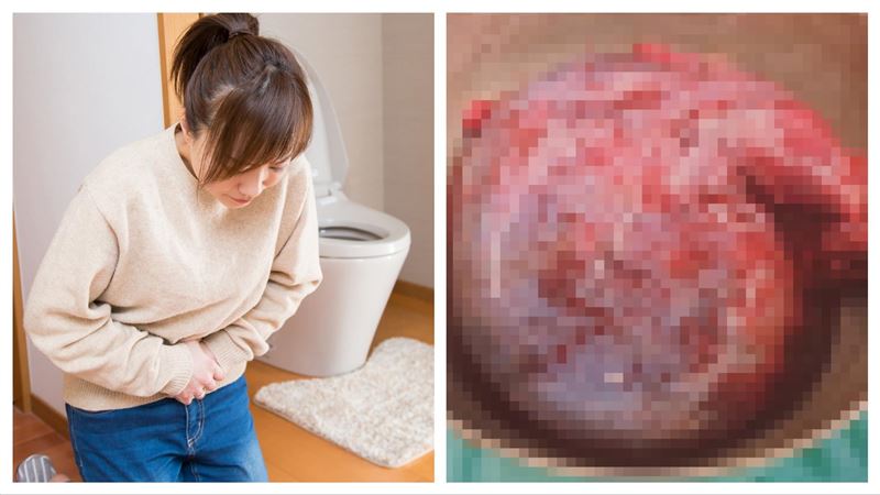 婦人腹痛就醫　取出「臉盆大」卵巢瘤