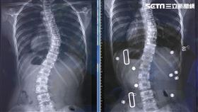 矯正前女學生脊椎成S形側彎(左圖)，穿帶背架後(右圖)明顯可見側彎角度獲改善（圖／光田綜合醫院提供）