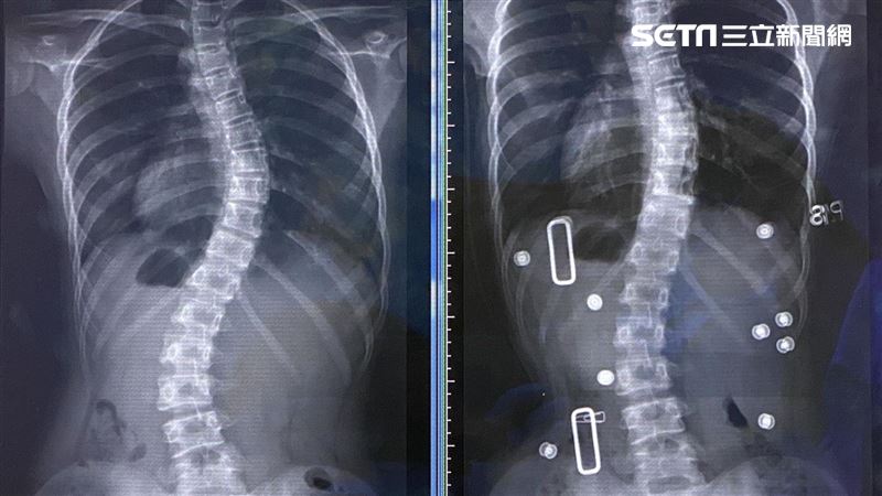 網路亂找偏方　14歲女脊椎側彎暴增