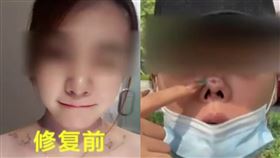 中國女直播主隆鼻手術4次，失敗慘凹大動，整個塌陷。（圖／
翻攝自微博）