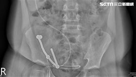 8歲童誤吞磁鐵　連續7天反覆嘔吐、肚子痛、險腸穿孔致命（圖／亞大醫院提供）