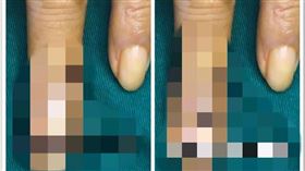 中國,浙江,魚,大叔,手指,刺傷,癌症（圖／翻攝自梨視頻）