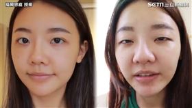 ▲許多人會尋求醫美手術改善單眼皮的問題。（圖／福爾思庭 授權）