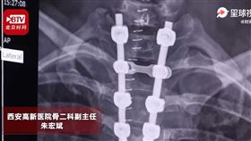 中國,陝西,健身,肚臍,伏地挺身,癱瘓（圖／翻攝自時間視頻）