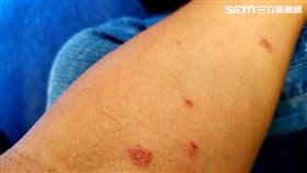 皮膚小傷口（圖／資料照）