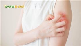 中度至重度異位性皮膚炎患者身體會發癢、脫屑、流組織液、皮膚角質化