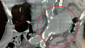 大千綜合醫院心臟外科主任楊智鈞醫師表示，腹主動脈瘤就像是體內的未爆彈，除了可以從躺著時摸肚子感覺「有一顆球在跳」之外，幾乎沒有其他症狀。（圖／大千綜合醫院提供）

