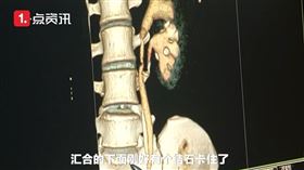 中國,武漢,醫師,腰痛,腎臟,輸尿管,結石（圖／翻攝自沸點視頻）