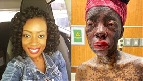 抗生素,水泡,史帝芬強生症候群(翻攝自 Rachel A. Carey 臉書)