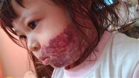葡萄酒色斑,顏損,女童,小玥（陽光基金會提供）