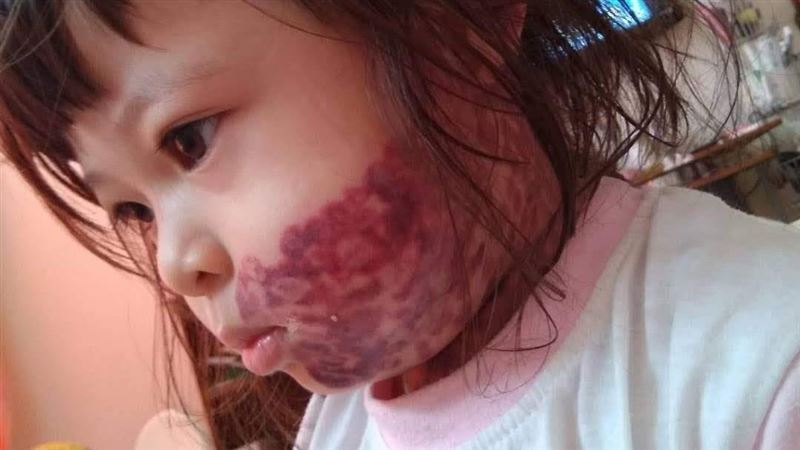 為治療顏損女童　水電工爸苦賺醫療費