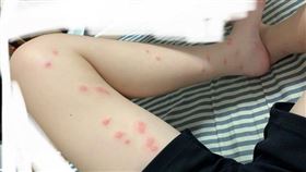 北投,溫泉,紅腫,蟲咬(翻攝自 Dcard)