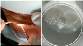 眼睛癢1年…他受不了才跑醫院！醫檢查嚇呆　抓近20條蟲，圖／翻攝自蘇州日報微博