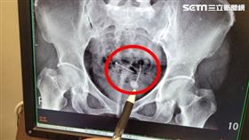 長安醫院泌尿科黃煒軒醫師表示，王女士因子宮避孕器藏體內廿年，造成她半年來反覆泌尿道感染及結石（圖／長安醫院提供）