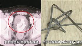 中國13歲男童好奇「尿道多深?」 把70cm電線塞到膀胱。（圖／翻攝自看看新聞微博）