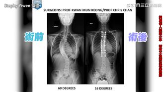 正妹脊椎側彎60度　手術後高4cm