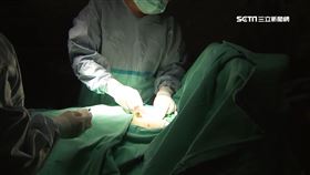 微創治子宮頸癌存活率降低？ 醫：台研究「沒差」