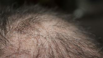 小心變禿頭！6萬人研究揭「喝2飲」害掉髮