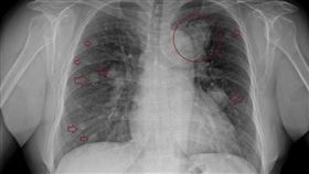 一名60歲婦女，久咳一年自行服用成藥與止咳中藥得到改善，但是最近開始咳嗽有血絲，終於才來胸腔科門診求助，結果一照X光已經是末期肺癌了，「圓圈處應該是原發的肺癌，其他箭頭處則是到處轉移的癌細胞……」（圖／蘇一峰醫師提供）
