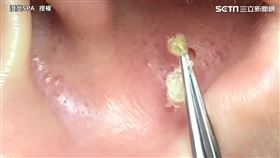 粉刺又勾又拉酥麻過程曝　美容師80秒拔除耳內大白蟲