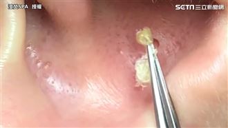 80秒拔除粉刺　又勾又拉酥麻過程曝