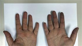 一名30多歲的OL日前常覺得手腳冰冷、手指發紫，指節末端更有輕微麻痛的感覺，檢查後竟罹患「雷諾氏症」。（圖：萬芳醫院提供）