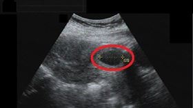 疤痕處子宮外孕／大千綜合醫院提供
