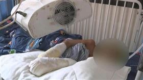 中國,廣東,男童,菸頭,燙傷（圖／翻攝自微博）