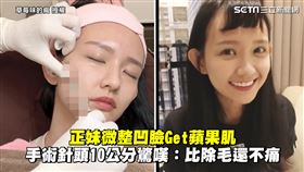 正妹微整凹臉Get蘋果肌　手術針頭10公分驚嘆：比除毛還不痛