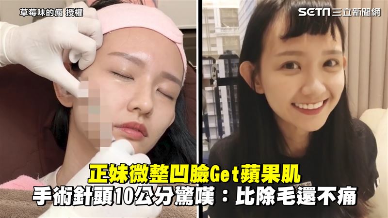 正妹微整填凹臉　術後臉膨膨年輕2歲