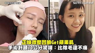 正妹微整填凹臉　術後臉膨膨年輕2歲