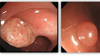 黑豹43歲大腸癌逝　她警告癌症兇殘
