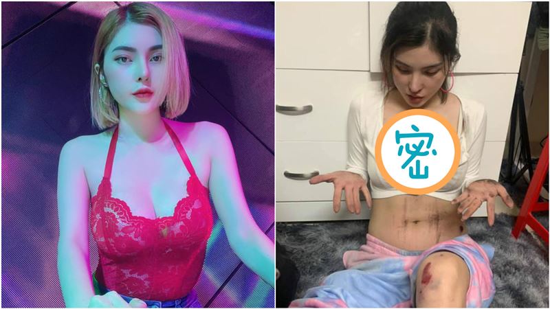 正妹遇劫雪乳擦傷　包紮照曝光網歪樓