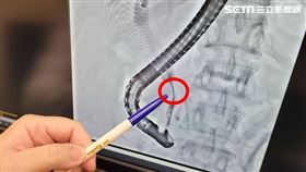 44歲女黃疸、體重減輕、上腹痛　檢查才知已罹｢膽管癌」（圖／長安醫院提供）