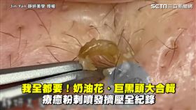 我全都要！奶油花、巨黑頭大合輯　療癒粉刺噴發擠壓全紀錄