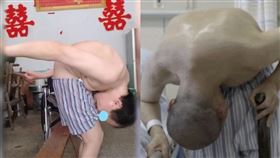 李華,摺疊人,僵直性脊椎炎,手術,180度彎曲