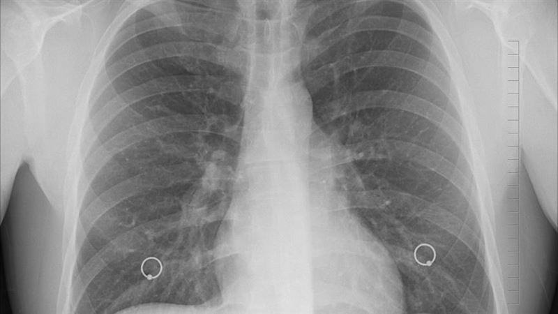 輕微碰撞就骨折　竟是癌症「骨轉移」