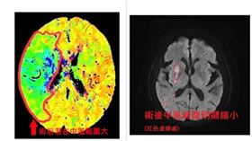 急性腦中風,中醫大新竹附醫,放射科,神經內科,三高