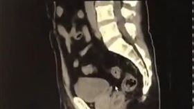 魚骨卡肛門以為犯痔瘡（圖／翻攝自看看新聞）