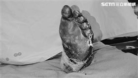 30歲男吃飯後突然昏迷　左腳掌發黑致敗血症、腎衰竭險死（圖／大林慈院提供）