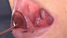 右側後臼齒區口腔癌，白斑清楚可見（圖／安南醫院提供）